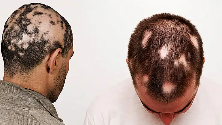 'Saçkıran' belirtilerine dikkat