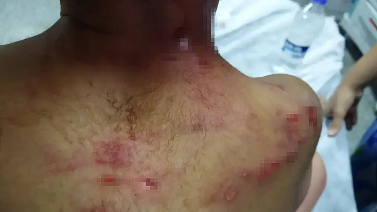 Köpeğin saldırısına uğrayan çocuğun kafasında derin yaralar oluştu