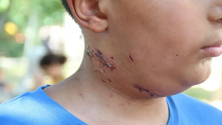 Köpek saldırısına uğrayan 10 yaşındaki çocuk ölümden döndü