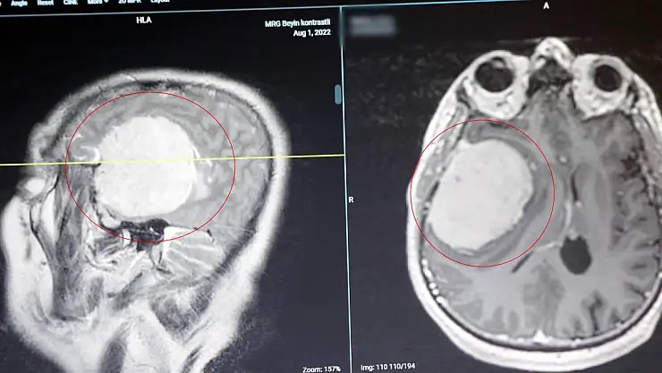 Beyin tümörlerinde zaman kaybı ölüme yol açıyor