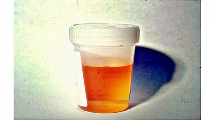 İdrarda kan görenler DİKKAT