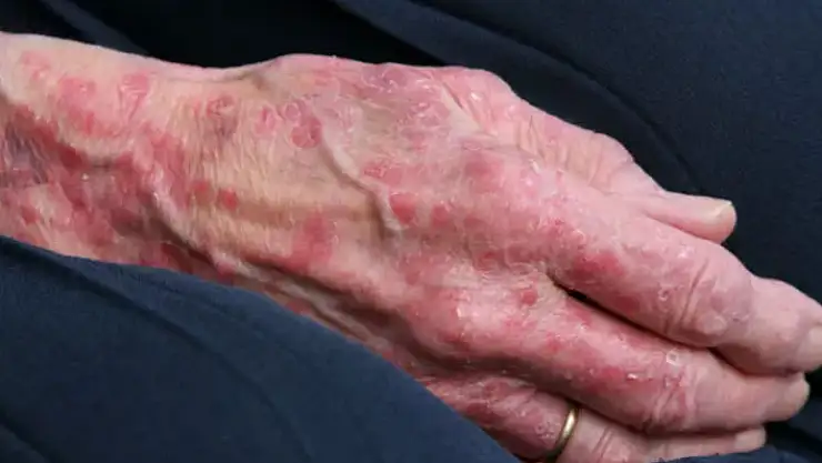 Cüzzam hastalığında erken tanı önemli