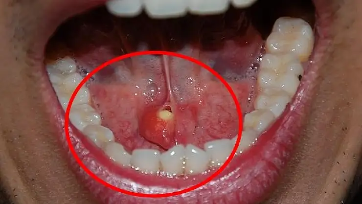 Tehlike Ağızda Gizli