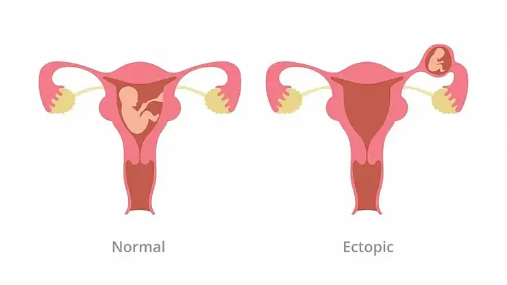 DIŞ GEBELİĞE DİKKAT!