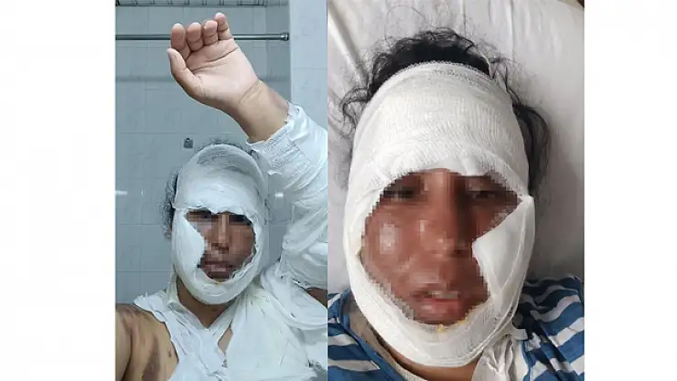 YÜZÜNE KAYNAR SU DÖKTÜ