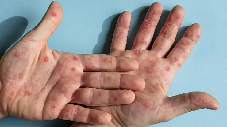 Hindistan'da ilk Maymun çiçeği virüsü görüldü