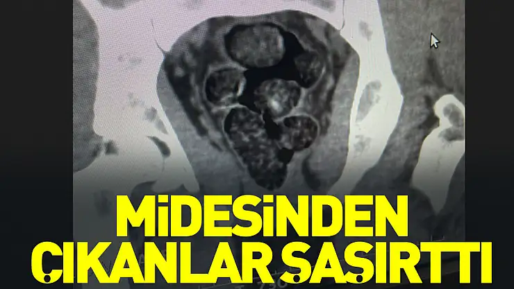 Midesinden çıkanlar şaşırttı