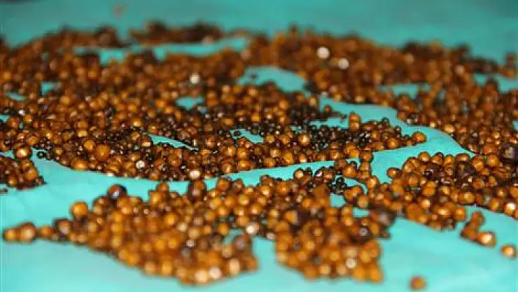 Safra kesesinden 4 bin 225 taş çıktı