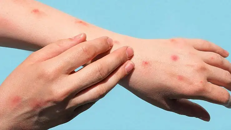 Almanya'da M-çiçeği virüsünün yeni varyantı ortaya cıktı