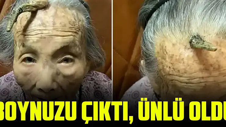 boynuzu çıktı, ünlü oldu