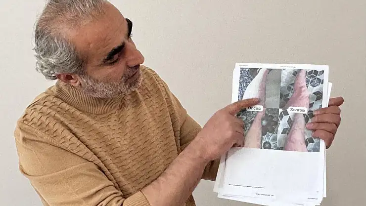 Jeoloji mühendisi sedef, egzama, uyuz ve vitiligo için krem üretti