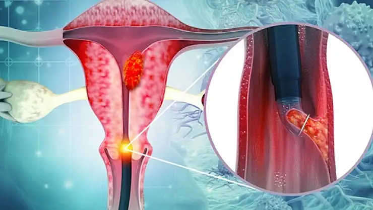 AŞI OLANLARDA KANSER RİSKİ YOK DENECEK KADAR AZ