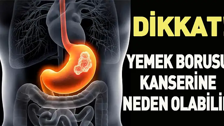 Kronik mide ekşimesi yemek borusu kanserine neden olabilir