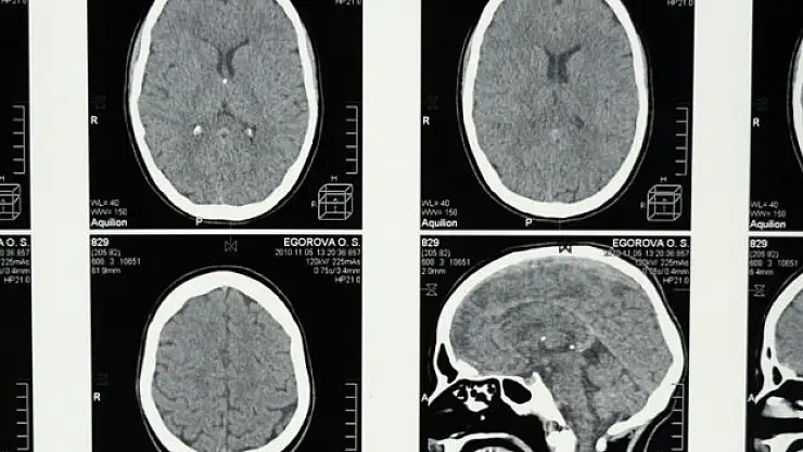 Alzheimer belirtisi olabilir