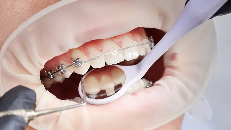 Ortodonti Tedavisi Hangi Yaşta Yapılmalı? Çocuklar ve Yetişkinler İçin Farklılıklar