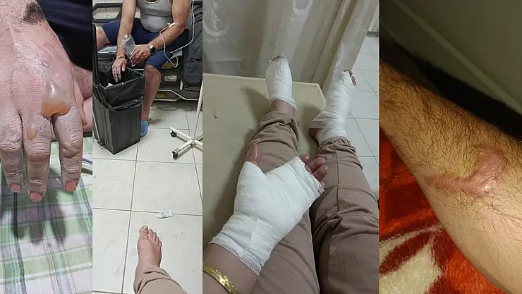 Lavabo açıcı patladı