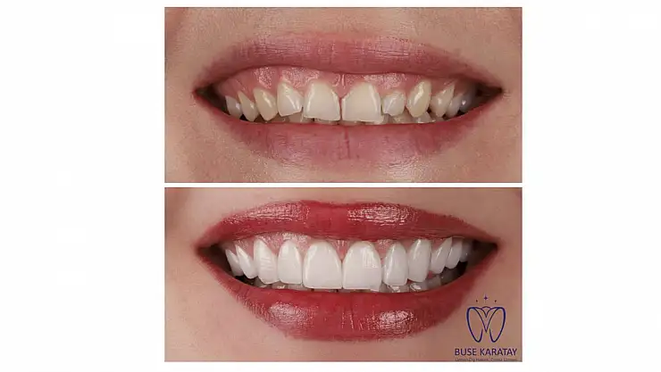 Estetik Bir Gülüş İçin Lamine Diş Çözüm mü?