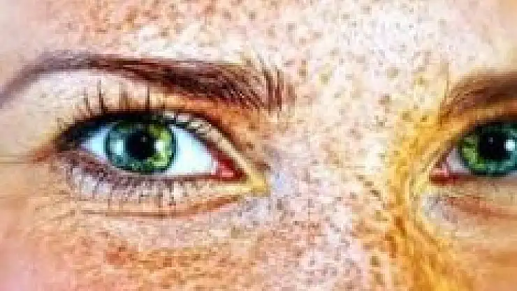 Vücudunuzdaki benler masum olmayabilir