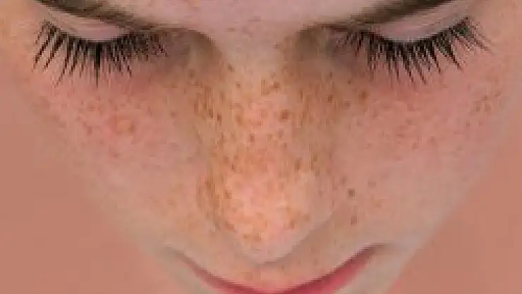 Güneş lekelerinden korunmanın yolları