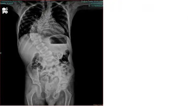 KARADENİZ'DE YENİ BİR AMELİYAT TEKNİĞİ UYGULANDI 