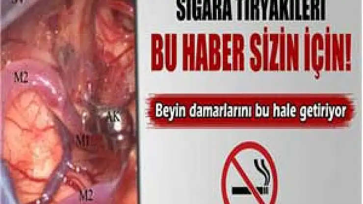 Sigara beyin damarlarını bu hale getiriyor