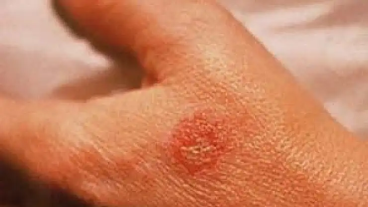 Egzama şikayetleri sıcak havalarda artıyor