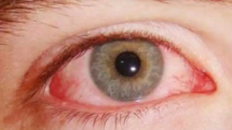 Gözde alerjiye dikkat!
