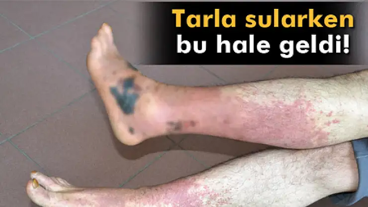 Tarlayı sularken mikrop kapan işçi yürüyemez duruma geldi