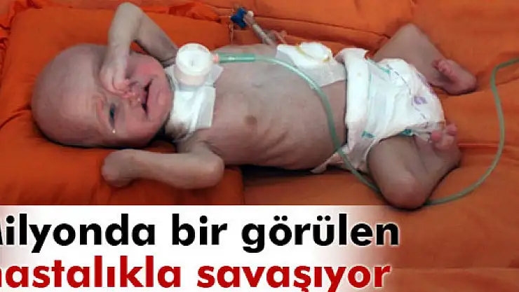 Minik Mustafa milyonda bir görülen hastalıkla savaşıyor