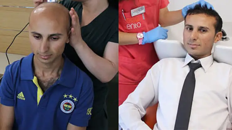 Saç ektirdi aynalarla barıştı