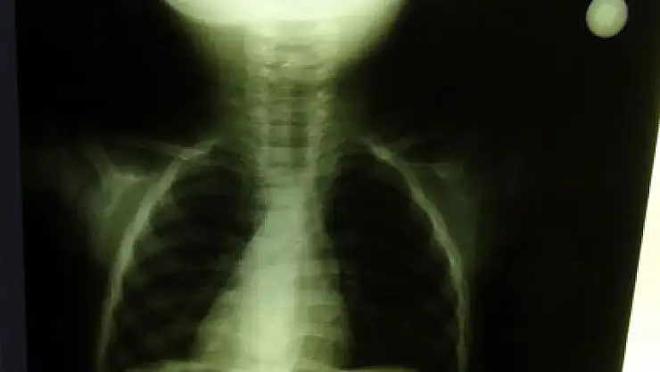 2 aylık bebeğin boğazına çengelli iğne kaçtı