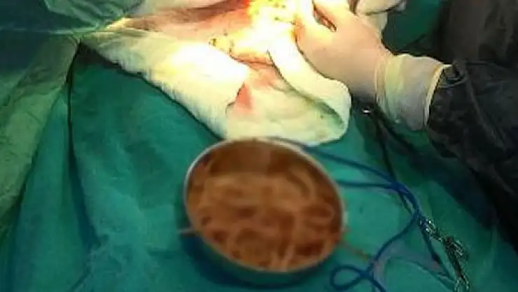 Beş yaşındaki çocuğun karnından 52 solucan çıkarıldı
