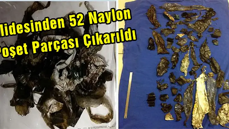  Midesinden 52 Naylon Poşet Parçası Çıkarıldı