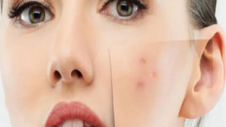 Akne ve sivilceye dikkat