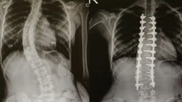 Omurga eğriliği olanlar OMÜ'de şifa buluyor