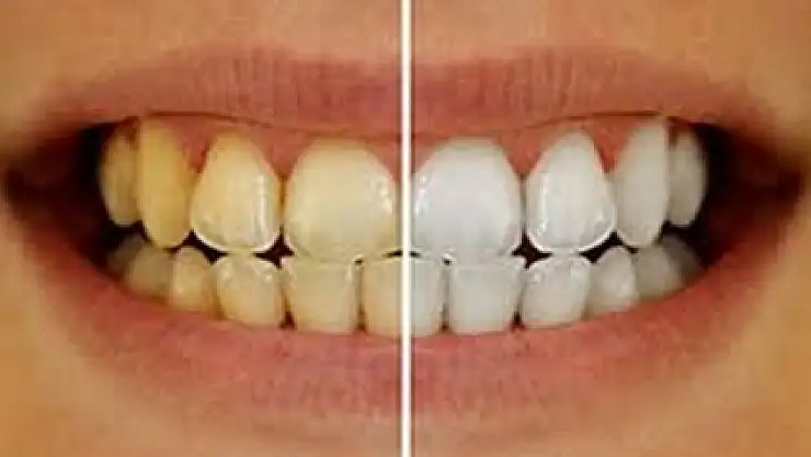 Dişlerdeki sararmayı ciddiye alın