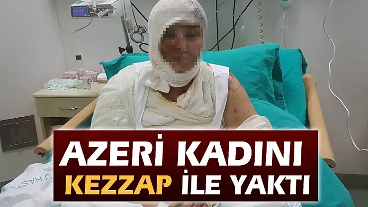 Azeri kadını kezzap ile yaktı