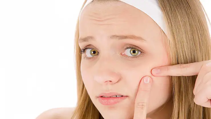 Sivilce tedavisinde doktor desteği şart