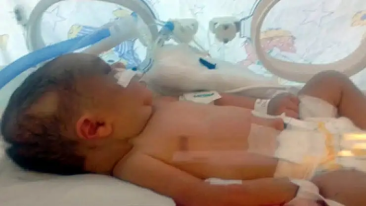 Kafatası çatlayan 6 günlük bebek, yaşam savaşı veriyor