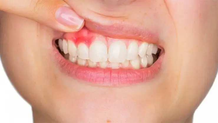 Diş çürüğü diğer hastalıkları tetikliyor!