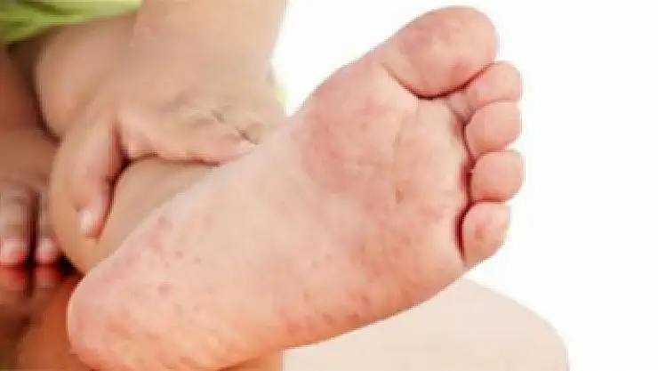 Vücudunuzda hızlıca yayılan kırmızı lekelere dikkat!