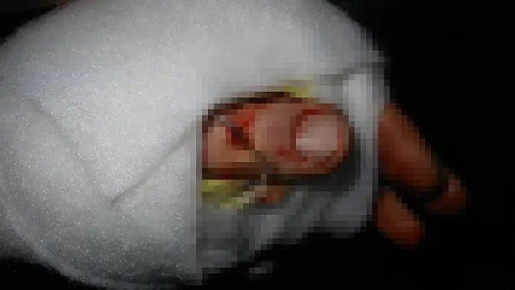 Parmak kopmasında ilk yapılması gerekenler 