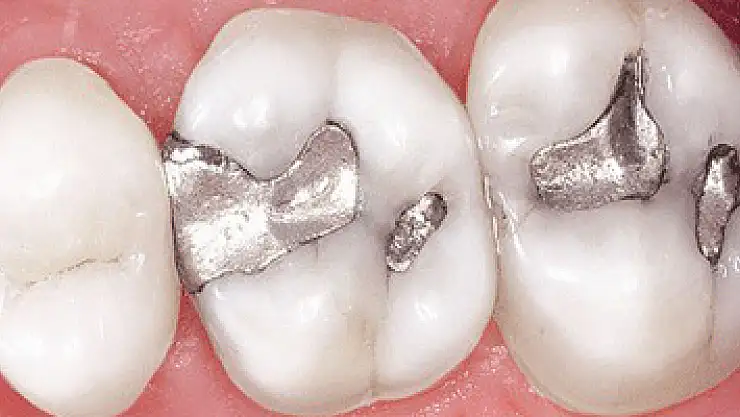 Diş dolgusu deyip geçmeyin