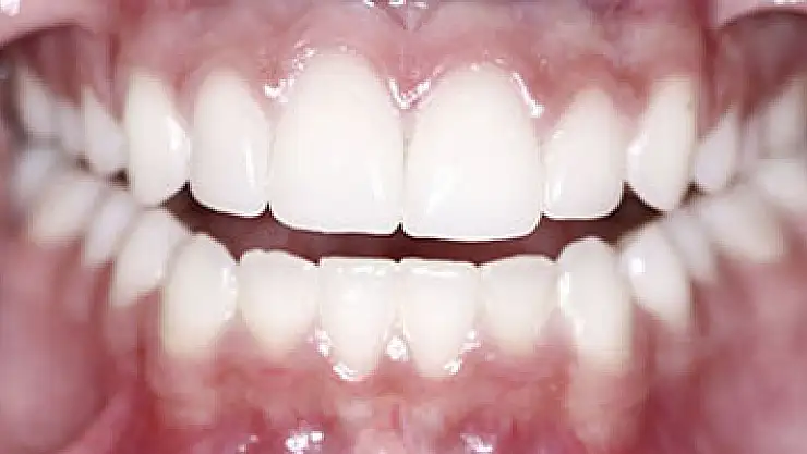 Diş etindeki renklenmeler hastalık belirtisi olabilir