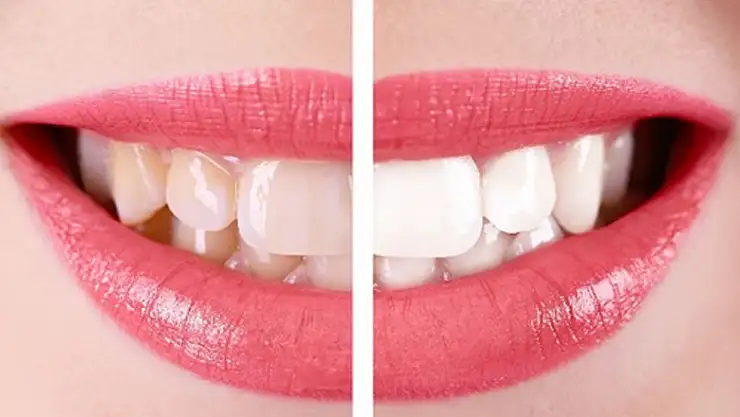 Dişte tercih edilen kaplama, zirkonyum