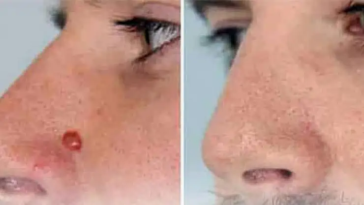 Ameliyatsız ben tedavisi