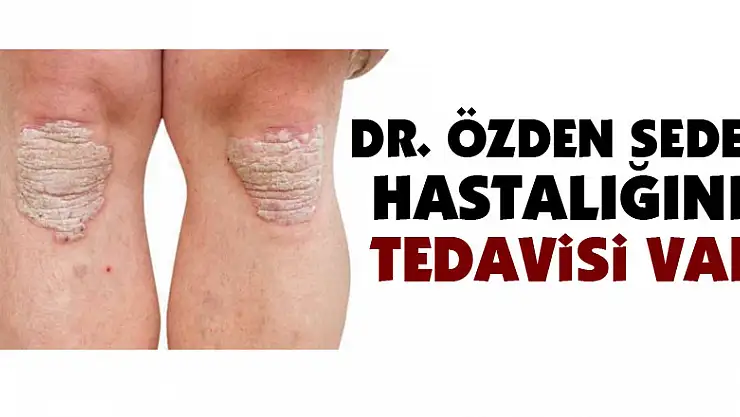 Dr. Özden: 'Sedef hastalığını tedavisi var'