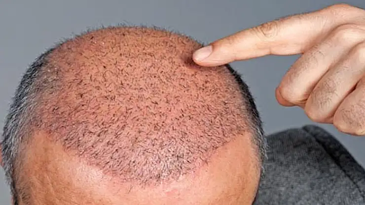 Saç ektiren kişilerde öz güven artıyor