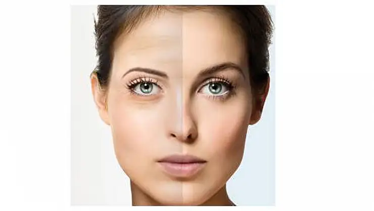 'Düşük göz kapağı etkiliyor'