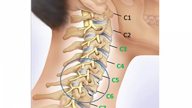 Boyun fıtığında cerrahi müdahale olmadan tedavi mümkün